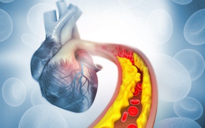 Có những cách nào để điều trị mỡ máu cao phòng ngừa bệnh tim mạch?