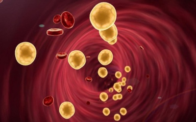 Thận trọng với mỡ máu cao, bước đệm dẫn tới bệnh tim mạch