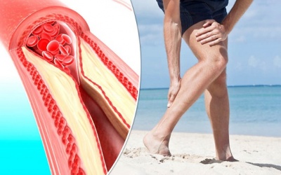 Người bệnh đái tháo đường cần cẩn thận với bệnh động mạch ngoại biên