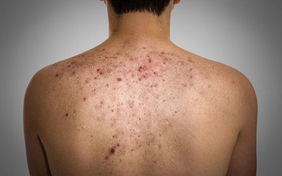 Mụn lưng – 4 nguyên nhân và cách khắc phục