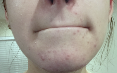 Trị dứt điểm mụn đầu đen ở cằm ngay tại nhà