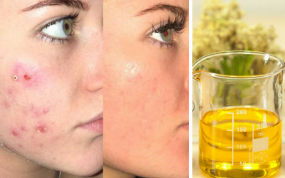 Sử dụng tinh dầu hoa anh thảo để trị mụn trứng cá có an toàn và hiệu quả?