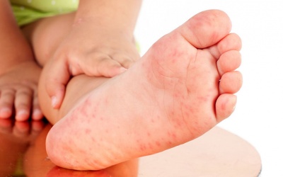 Triệu chứng mới của Covid-19: Cảnh giác với những vết bầm tím ở ngón chân của trẻ