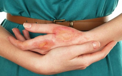 5 biện pháp làm dịu vết bỏng tại nhà