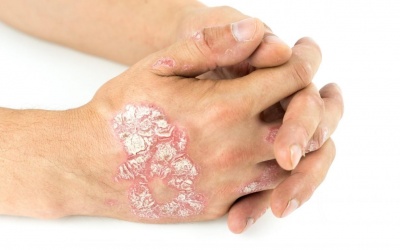 Các phương pháp điều trị vảy nến cho người cao tuổi