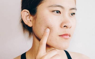 8 nguyên liệu tự nhiên giúp bạn trị mụn ngay tại nhà