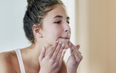 5 điều cần biết để chăm sóc da mụn ở độ tuổi dậy thì