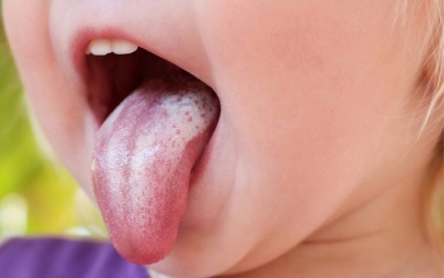Biện pháp khắc phục nấm miệng (tưa lưỡi) ở trẻ nhỏ