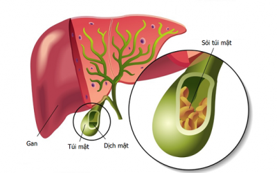 Sỏi túi mật 13mm chưa có triệu chứng đã phải phẫu thuật không?