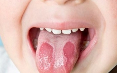 Dấu hiệu bất thường ở lưỡi cảnh báo bệnh mạn tính nguy hiểm