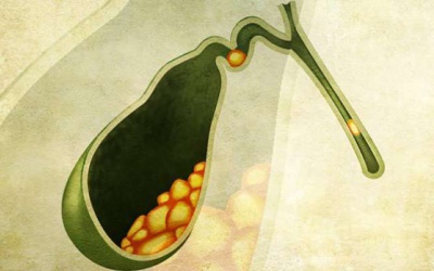 Có thể làm gì để ngăn ngừa sỏi mật, giữ túi mật khỏe mạnh?