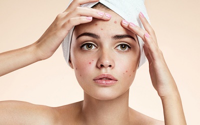 5 loại thực phẩm gây mụn trứng cá 