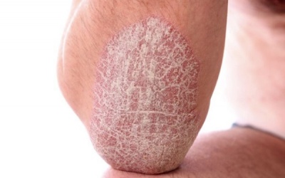 3 lưu ý giúp cải thiện triệu chứng vảy nến