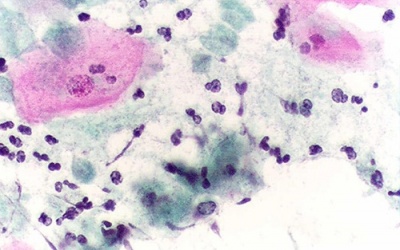 Candida: Sinh vật “thèm” đường gây tăng cân, béo phì