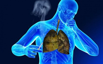 Hút thuốc lá liên quan tới 6/8 nguyên nhân gây tử vong hàng đầu