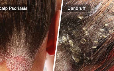 Cách nhận biết vảy nến và gàu