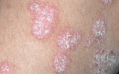 Bệnh vảy nến ảnh hưởng đến phổi như thế nào?