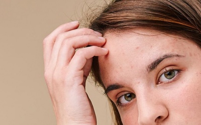 Tại sao bạn có thể bị nổi mụn ở da dầu và cách khắc phục?