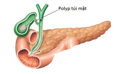 Polyp túi mật có thể tự biến mất không?