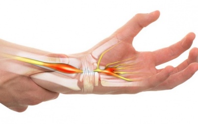 Bệnh suy giáp làm tăng nguy cơ mắc hội chứng ống cổ tay?