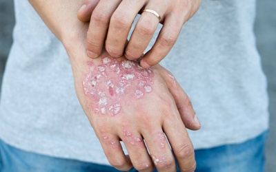 Dầu cá có giúp điều trị bệnh chàm?