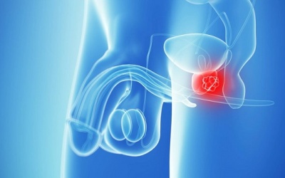 Điều trị ung thư tuyến tiền liệt bằng liệu pháp hormone có hiệu quả?