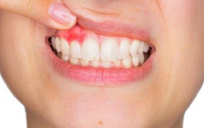 Viêm lợi có thể lây?