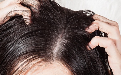 Cách trị gàu bằng lá neem đơn giản nhưng ít ai biết
