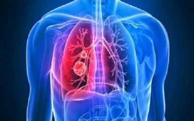 Những dấu hiệu cảnh báo xơ phổi vô căn có thể bạn không biết