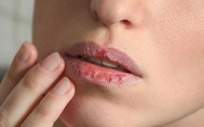 Khắc phục đôi môi khô, nứt nẻ bằng 9 loại tinh dầu thiên nhiên