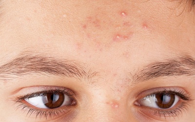 Mách bạn 7 cách dùng bột yến mạch để trị mụn đầu trắng