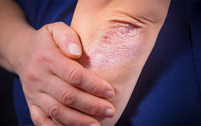 9 dấu hiệu bạn có thể mắc bệnh viêm khớp vảy nến