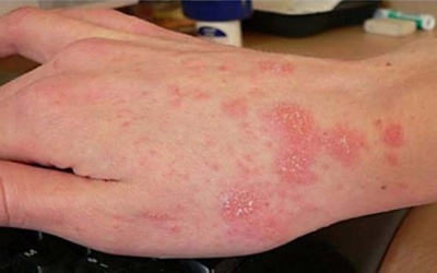 Bạn đã biết cách trị bệnh ghẻ tại nhà?