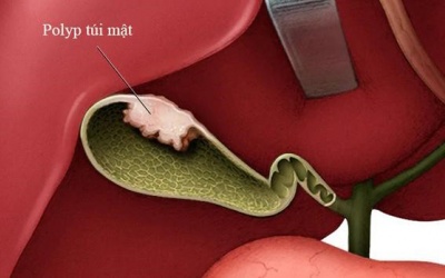  Nguyên nhân và cách làm giảm các triệu chứng do polyp túi mật 
