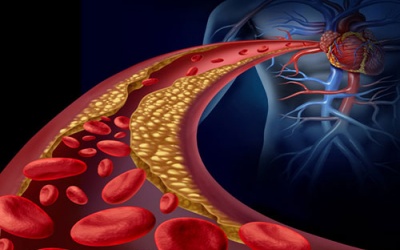 Tăng huyết áp vô căn: Căn bệnh âm thầm mà nguy hiểm!