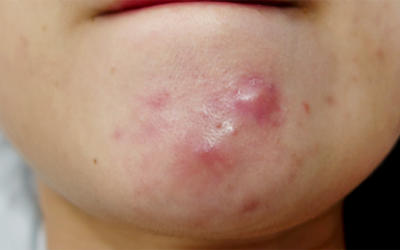 Thoát khỏi mụn nang đơn giản bằng 5 nguyên liệu tự nhiên 