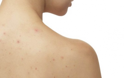 Mách bạn cách “đánh bay” mụn ở lưng tại nhà hiệu quả