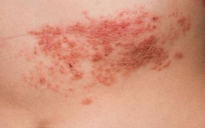 Bao lâu tôi mới thoát khỏi cơn đau của bệnh zona?