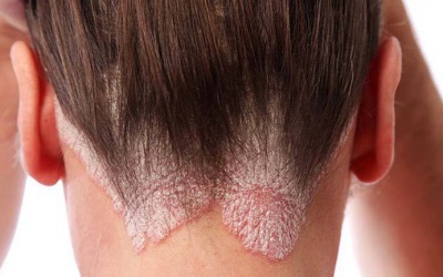 Dấu hiệu của bệnh vảy nến da đầu