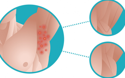 Cải thiện bệnh viêm tuyến mồ hôi mủ bằng cách nào?