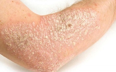 Bị vảy nến bôi thuốc gì cho hiệu quả nhanh, an toàn? 