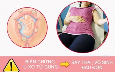 Bệnh u xơ tử cung có nguy hiểm không?