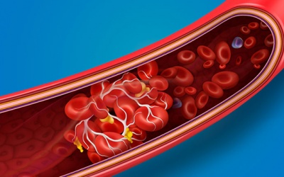 Cẩn thận các triệu chứng cảnh báo cục máu đông trong cơ thể