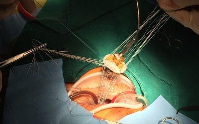 Bị hở van 2 lá nên thay van cơ học hay van sinh học?