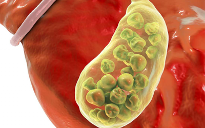 Đã cắt túi mật nhưng sỏi mật vẫn tái phát, phải làm sao?