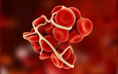 Tại sao cục máu đông có thể gây tai biến mạch máu não?