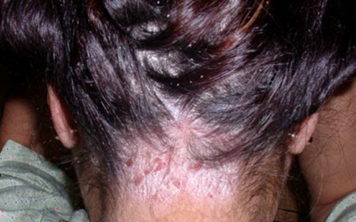 5 nguyên liệu tự nhiên giúp trị vẩy nến da đầu ngay tại nhà