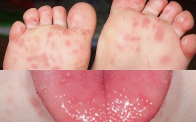 Bệnh tay chân miệng có nguy hiểm không, xử lý thế nào?