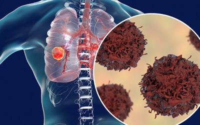 Gia đình có tiền sử ung thư: Làm thế nào để phòng ngừa ung thư phổi?