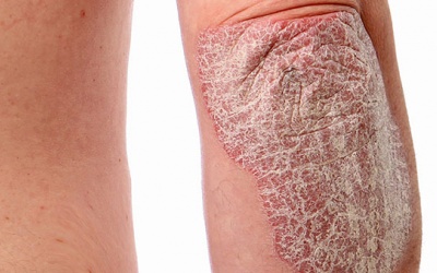 Những thực phẩm người bị vảy nến cần tránh